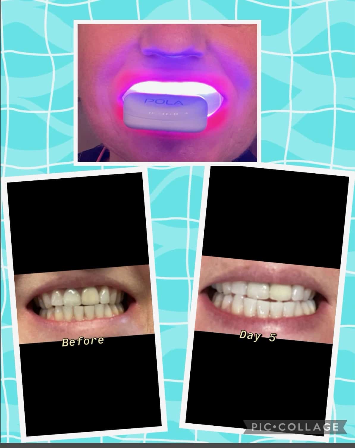 PolaLight Teeth Whitening