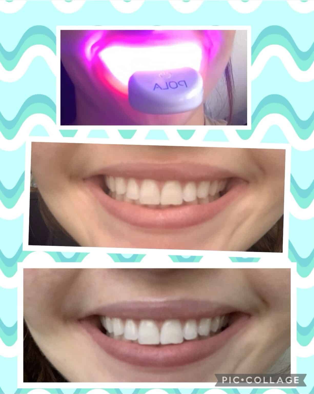 Effortless Whitening: Burst Strips For A Confident Smile - ld2nonv